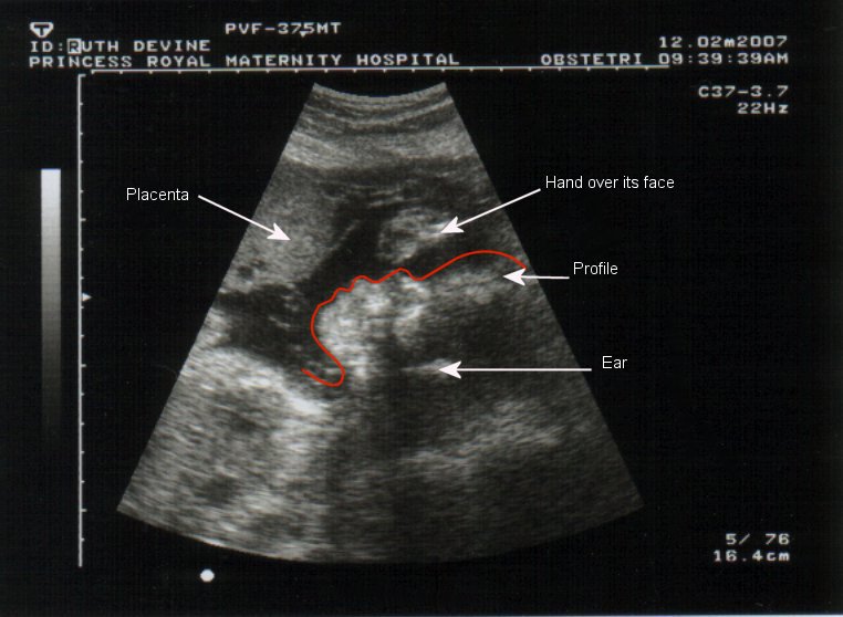 Scans Of Twins. Clarifying the Baby Scans Wed,
